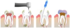 Endodoncia